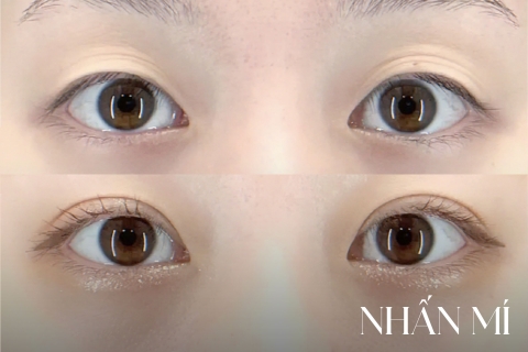 Nhấn mí